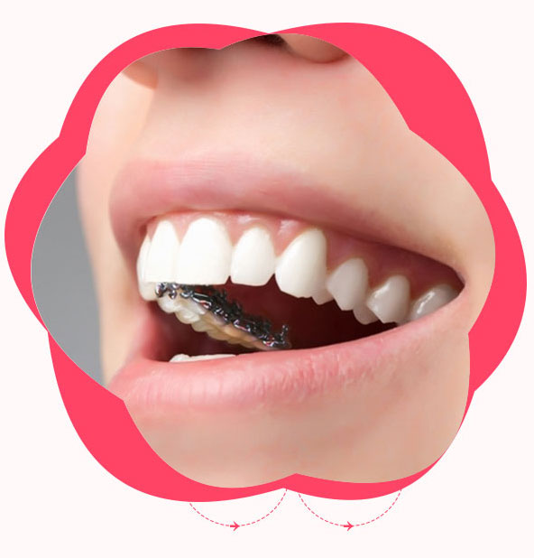 數碼舌側隱形正畸